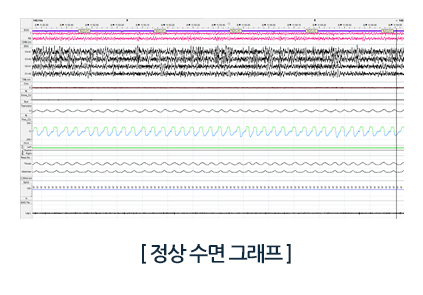 하지불안증후군