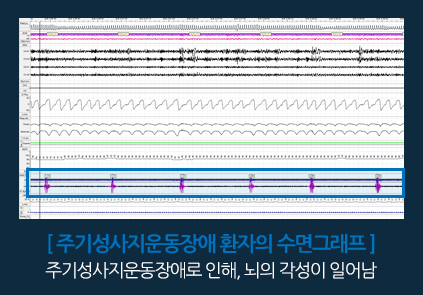 하지불안증후군