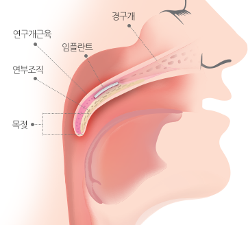 임플란트를 삽입해 코골이를 막아주는 방법