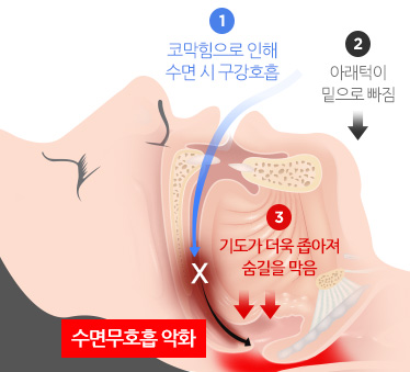 코막힘 코골이 수면무호흡